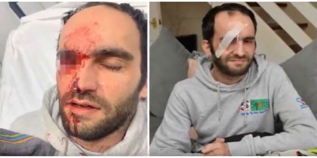 Έχασε το μάτι του όταν «συγκρούστηκε» με ένα… αυγό (βίντεο)