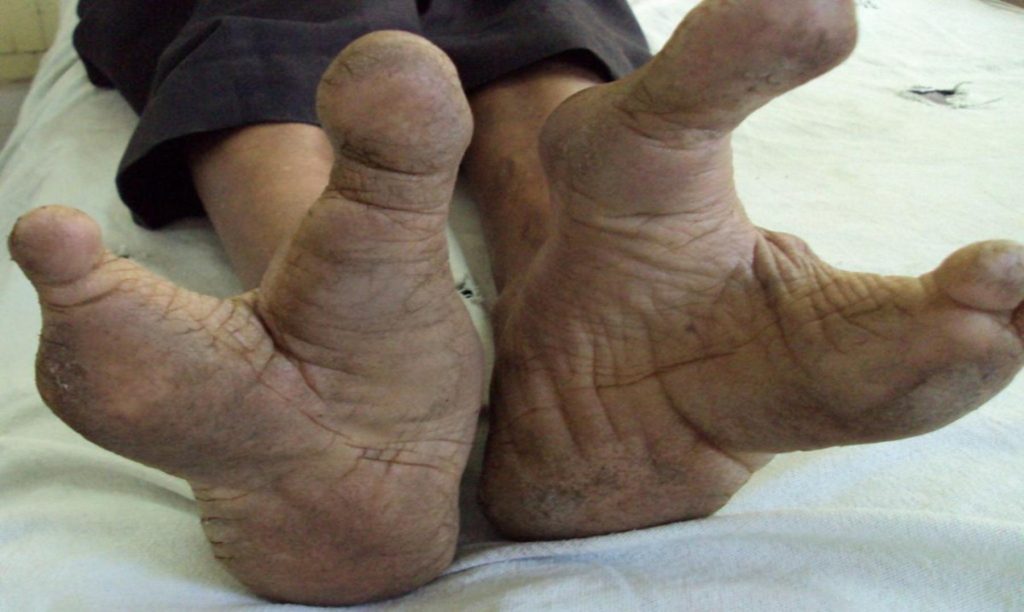 Φυλή Vadoma: Οι άνθρωποι με τα πόδια που θυμίζουν στρουθοκάμηλο (φωτό, βίντεο)