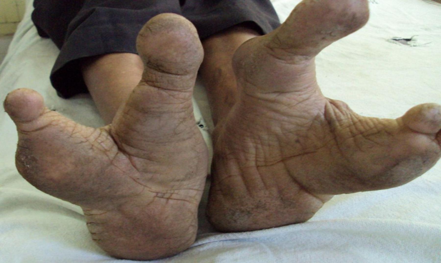 Φυλή Vadoma: Οι άνθρωποι με τα πόδια που θυμίζουν στρουθοκάμηλο (φωτό, βίντεο)