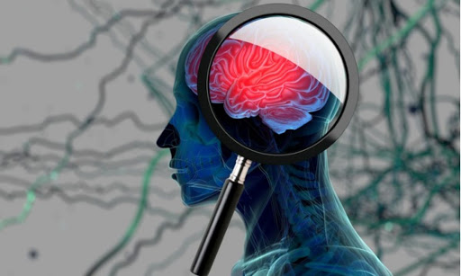 Ανεύρυσμα εγκεφάλου: Προσοχή σε αυτά τα «αθώα» πρώιμα συμπτώματα