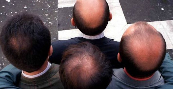 Μην το κάνεις ποτέ: Οι 2 πιο γελοίοι τρόποι να κρύψεις την καράφλα σου (φωτο)