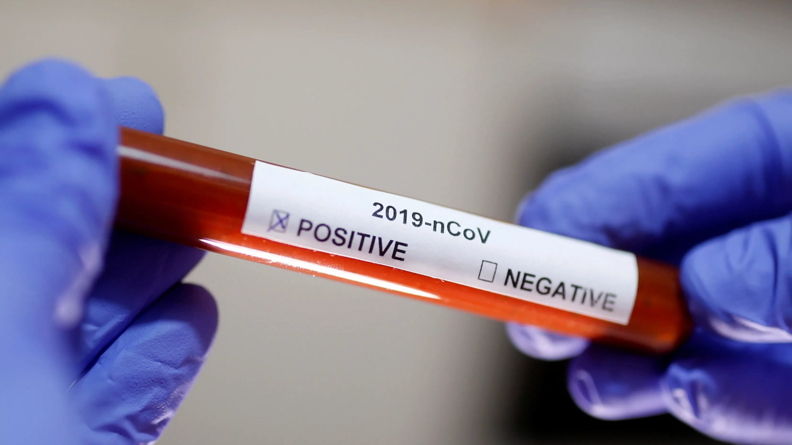 Κορωνοϊός: Εγκρίθηκε τεστ αίματος που βγάζει αποτέλεσμα σε 15-20 λεπτά – Θα δείχνει και ποιοι έχουν ανοσία