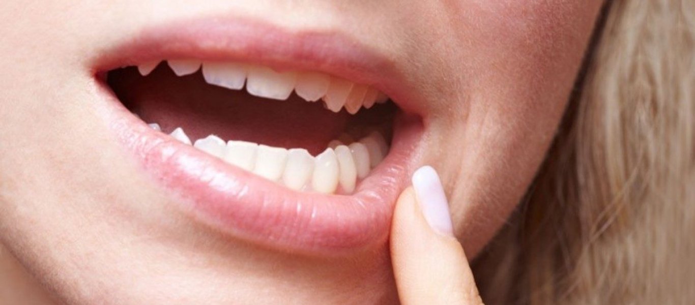 Ούλα που ματώνουν; – Δείτε πως να το καταπολεμήσετε με φυσικό τρόπο