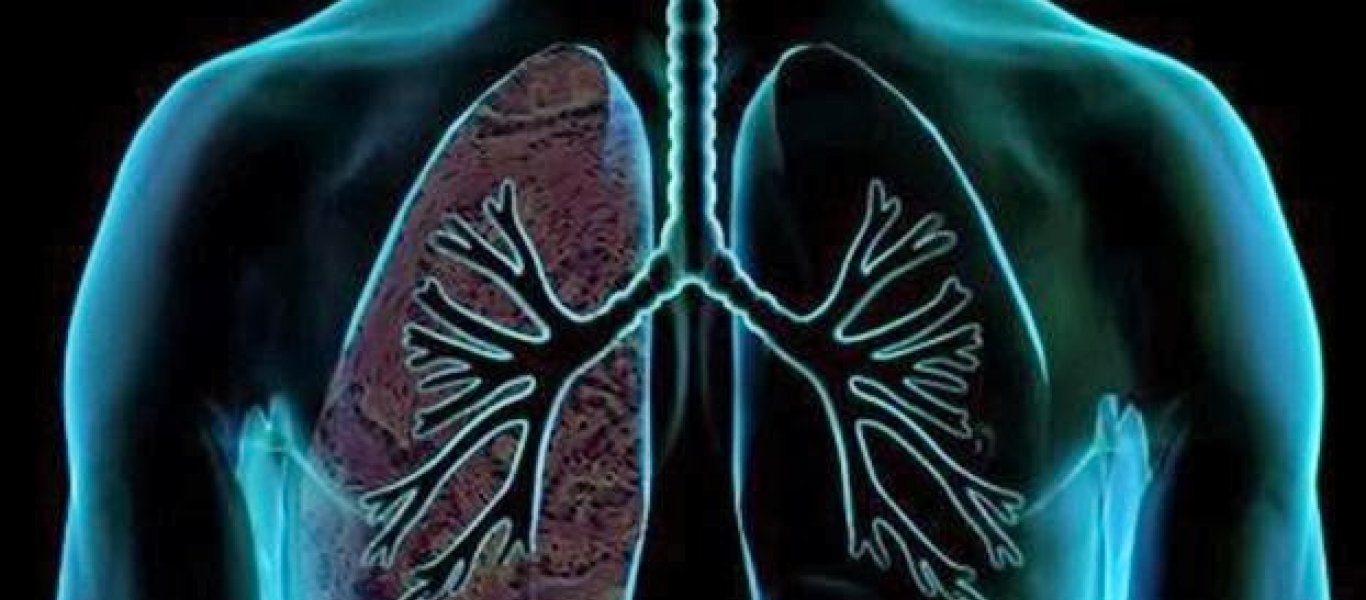 Μικροκυτταρικός καρκίνος του πνεύμονα: Τα συμπτώματα του πολύ επιθετικού καρκίνου (βίντεο)