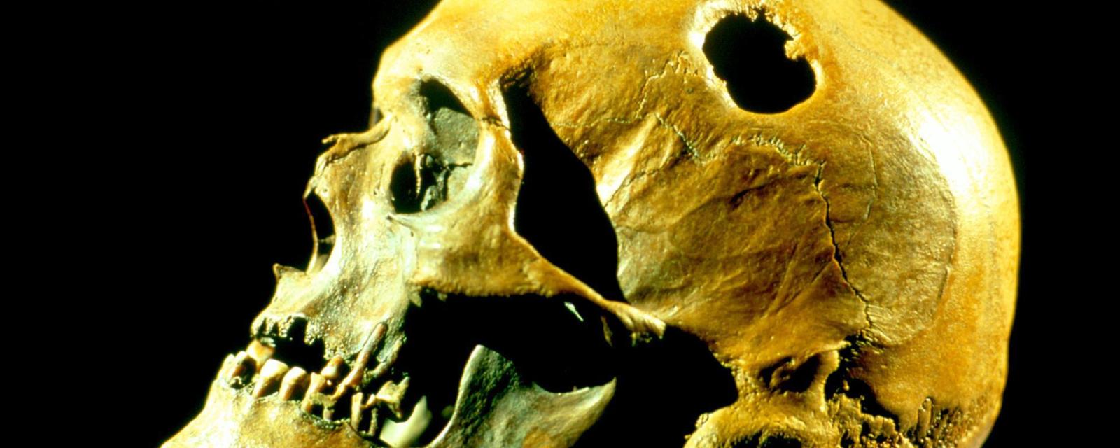 Γιατί είχαν τρύπες τα κεφάλια των Αρχαίων Ελλήνων; – Τι ανακάλυψαν οι επιστήμονες;