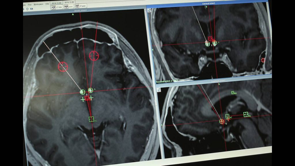 Του εμφύτευσαν συσκευή στον εγκέφαλο για να κόψει τις ναρκωτικές ουσίες