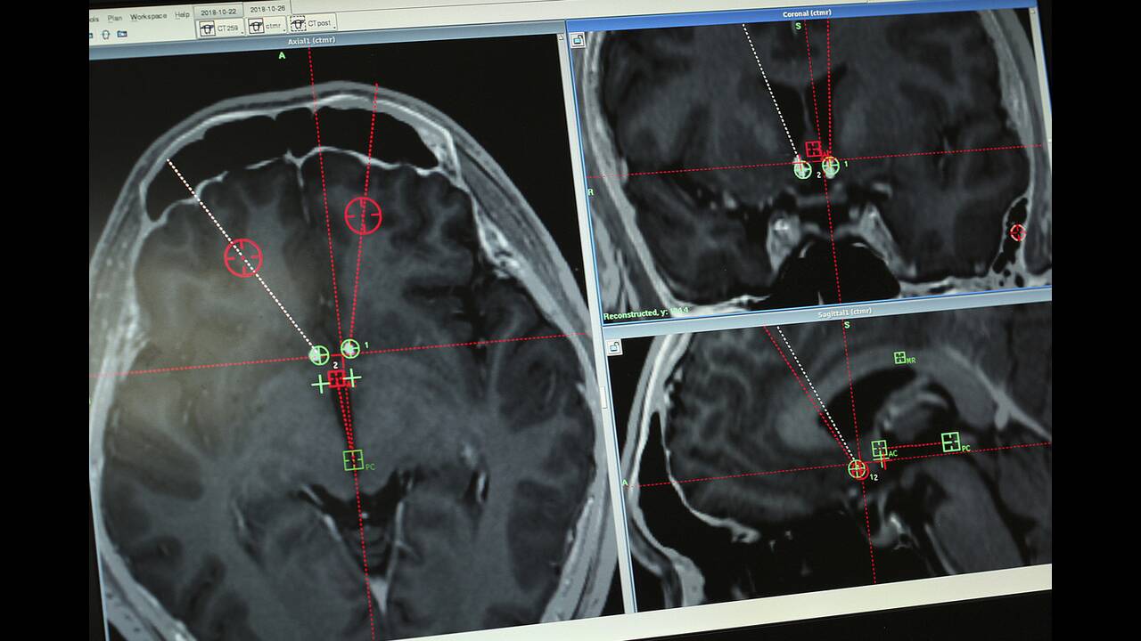 Του εμφύτευσαν συσκευή στον εγκέφαλο για να κόψει τις ναρκωτικές ουσίες