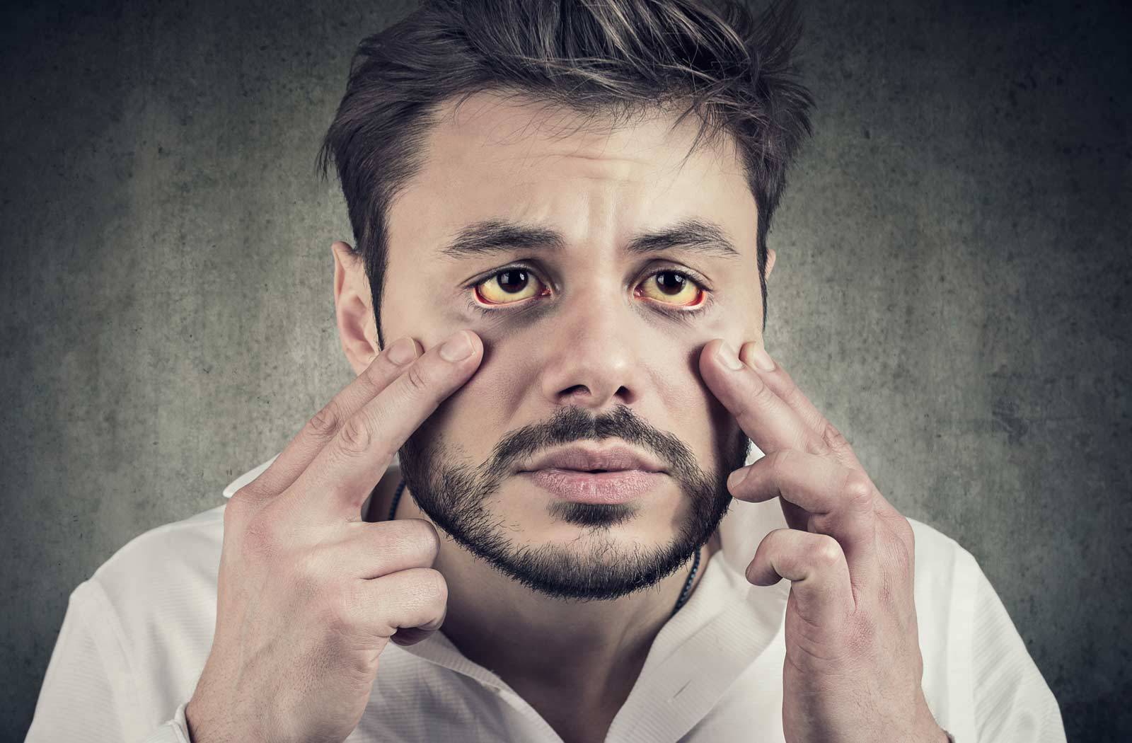 Κίτρινα μάτια: Με ποιες ασθένειες συνδέονται – Ποιοι πρέπει να προσέχουν
