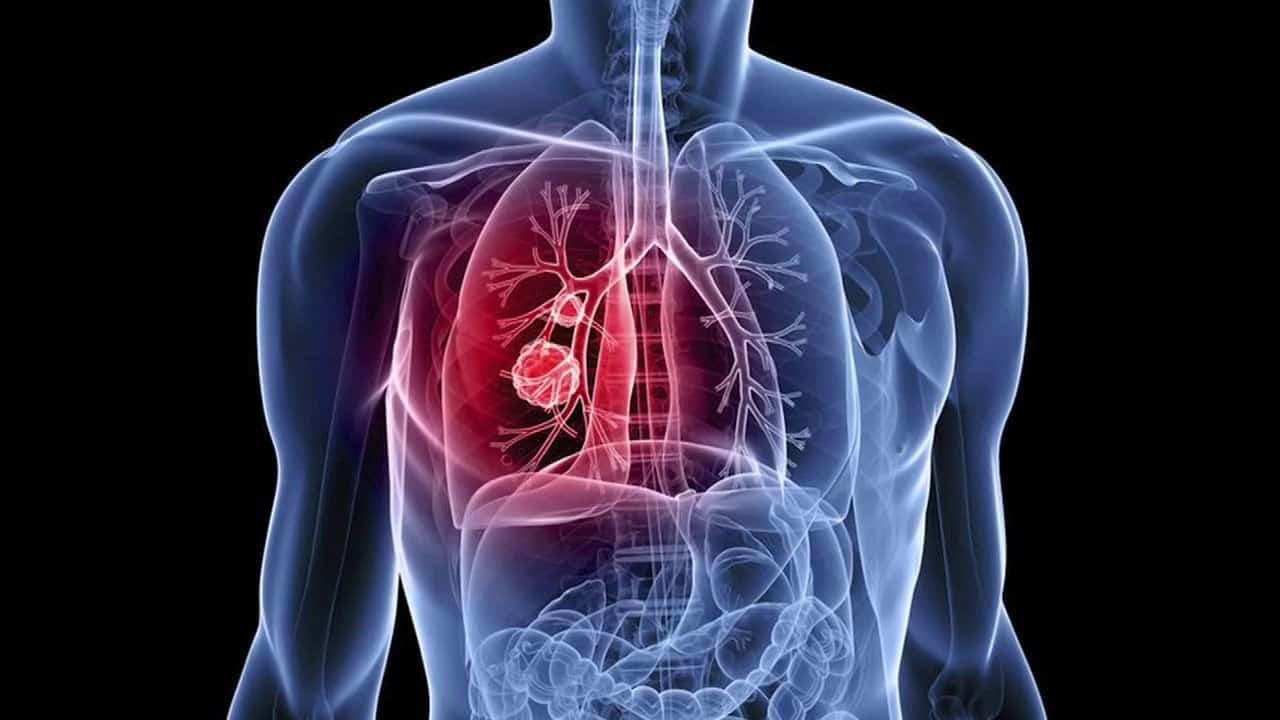 Καρκίνος του πνεύμονα: Τι προκαλεί η νικοτίνη – Τι δείχνει νέα έρευνα