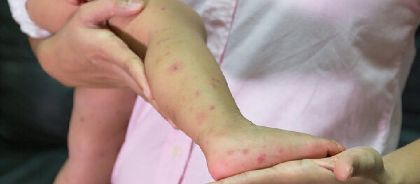 Ιός Κοξάκι στα παιδιά: Συμπτώματα, πρόληψη κι αντιμετώπιση