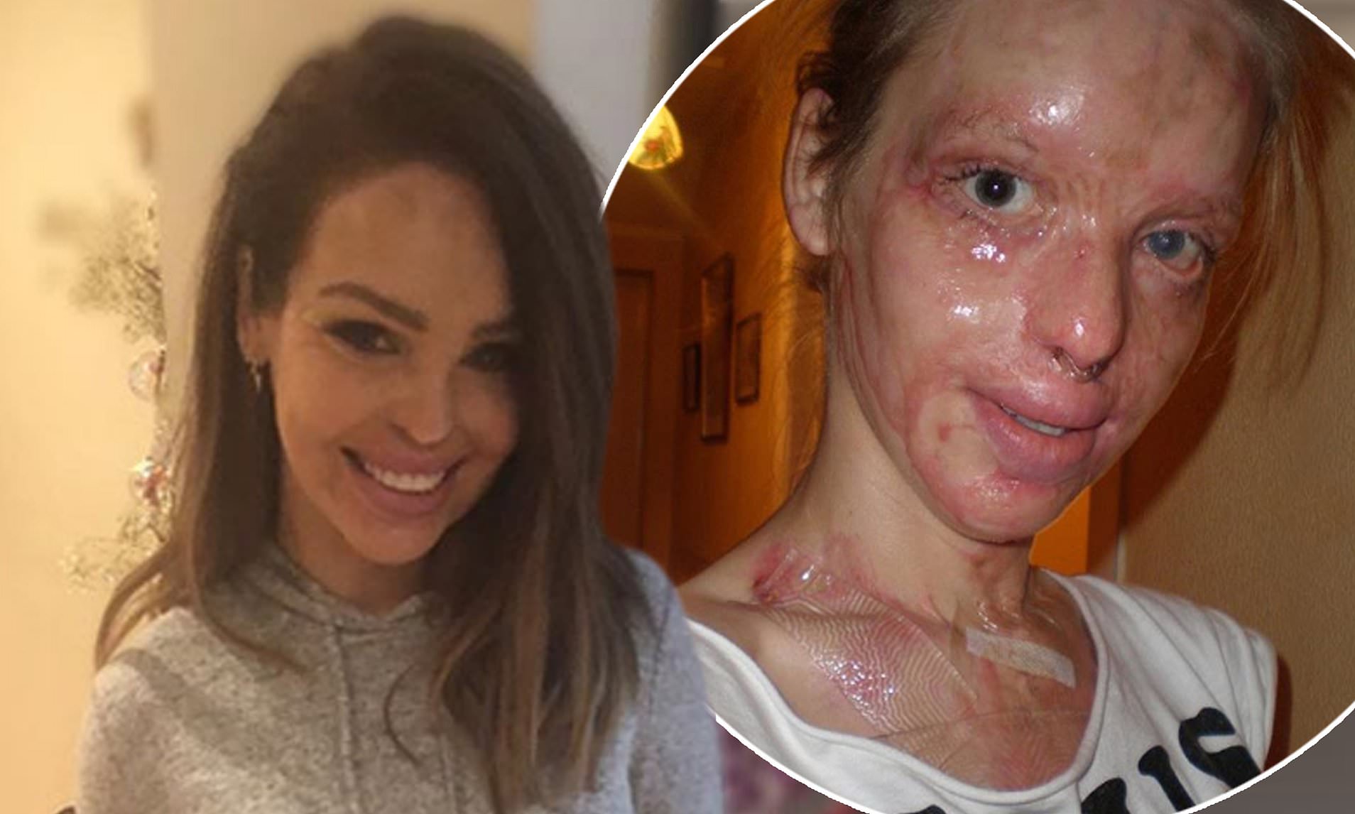 Η επίθεση με οξύ στην 24χρονη Katie Piper: Τα 40 χειρουργεία & το θαύμα της αποκατάστασης (βίντεο)
