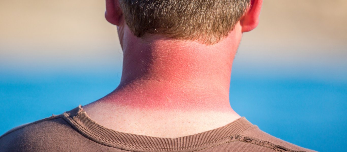 «Καήκατε» από τον ήλιο; – Δείτε πως θα ανακουφιστείτε άμεσα