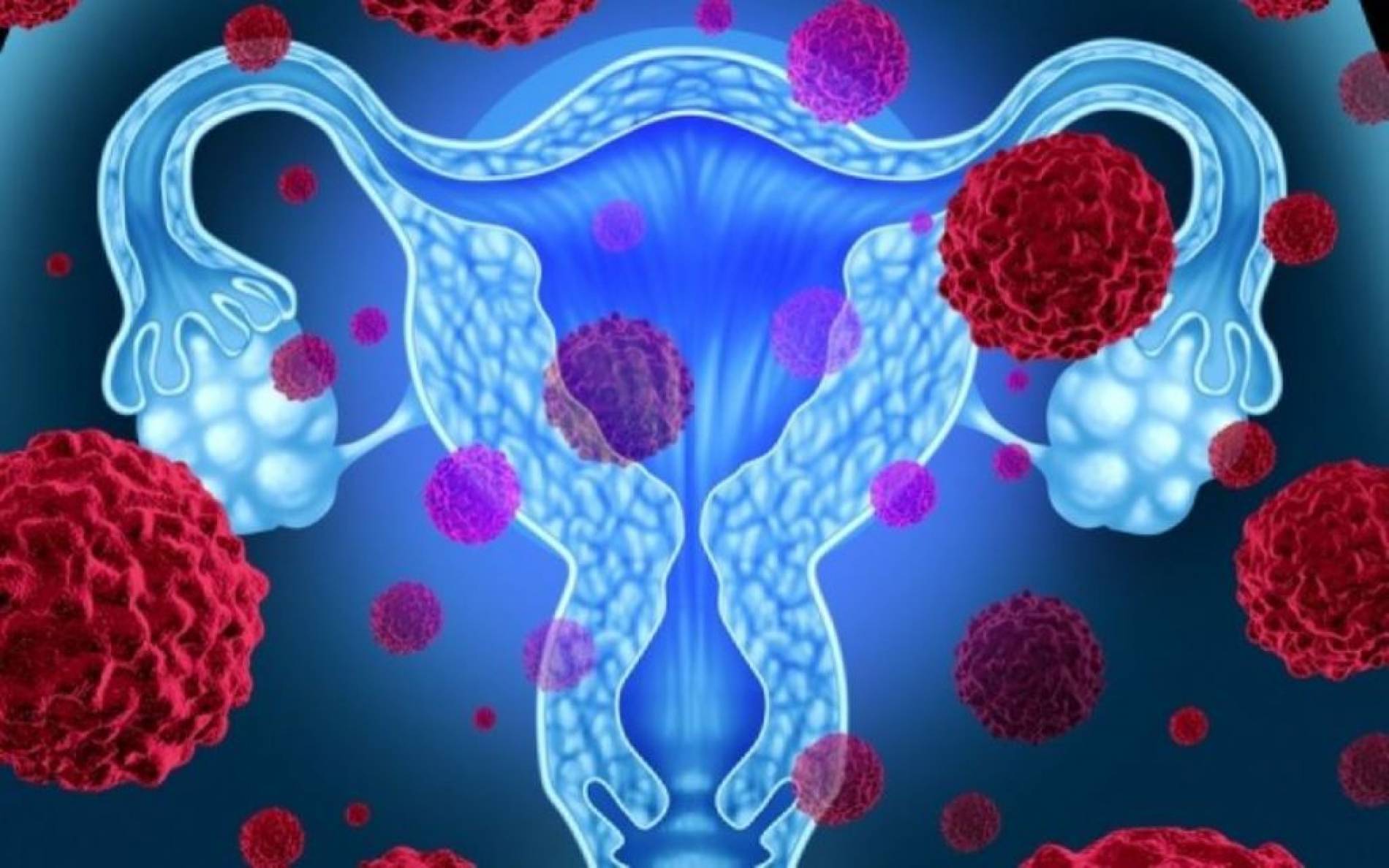 Καρκίνος των ωοθηκών: Τα πρώιμα συμπτώματα που δεν πρέπει να αγνοήσετε