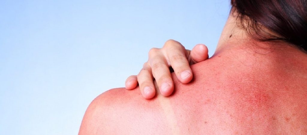 Ηλιακό έγκαυμα: Αντιμετώπισέ το με αιθέρια έλαια