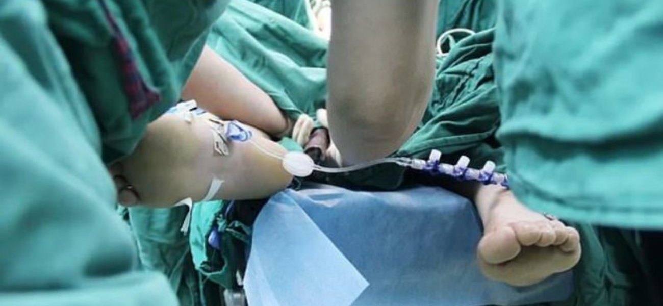 Απίστευτο και όμως αληθινό: Του καρφώθηκε ράβδος ενός μέτρου ανάμεσα στα πόδια και επέζησε (φώτο)