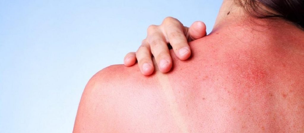 Τι πρέπει να κάνετε για να μην ξεφλουδίσετε από τον ήλιο