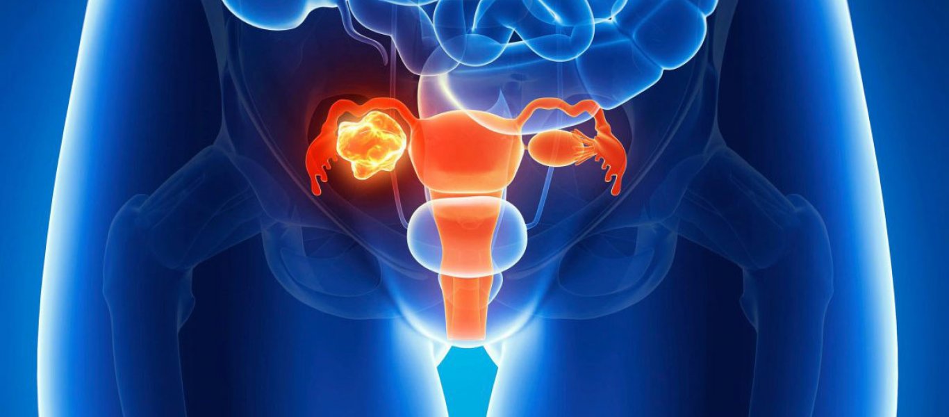 Καρκίνος των ωοθηκών: Προσοχή σε αυτά τα πρώιμα συμπτώματα – Πότε πρέπει να δείτε γιατρό