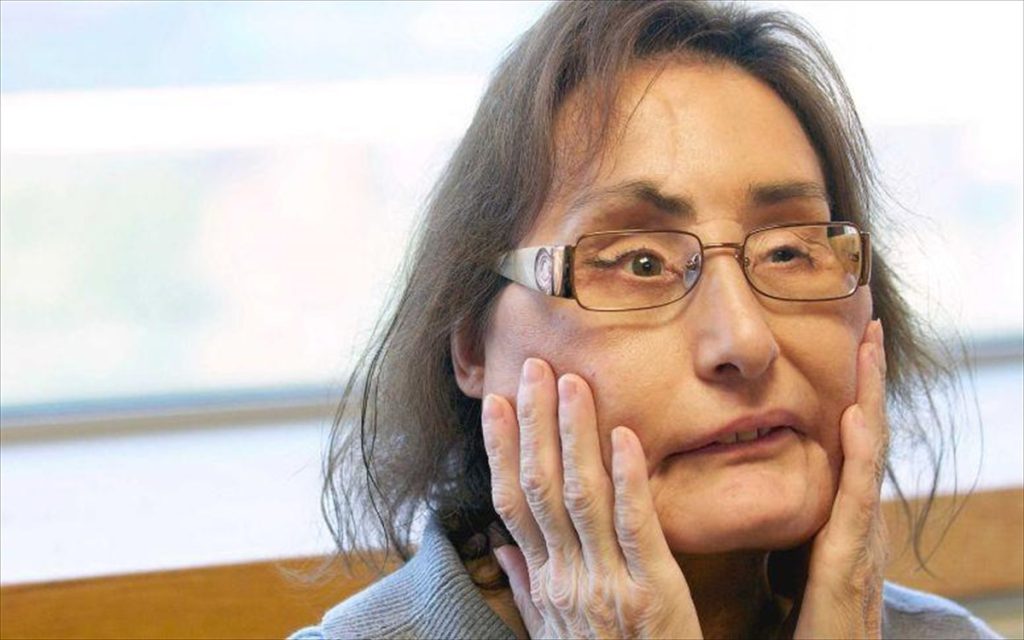 ΗΠΑ: Πέθανε η πρώτη Αμερικανίδα που έκανε μεταμόσχευση προσώπου (φωτο)