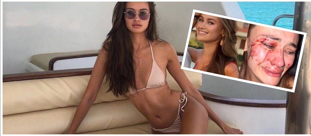 Μοντέλο από την Ουκρανία καταγγέλλει τον άγριο ξυλοδαρμό της σε παραλιακό κλαμπ της Τουρκίας (φώτο-βίντεο)