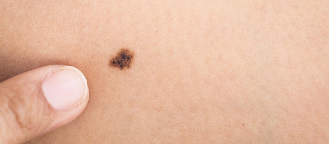 Ελιά στο δέρμα: Τα πέντε σημάδια που δείχνουν κίνδυνο για καρκίνο