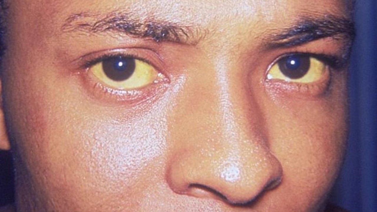 Κίτρινα μάτια: Τι «μαρτυρούν» για την υγεία σας