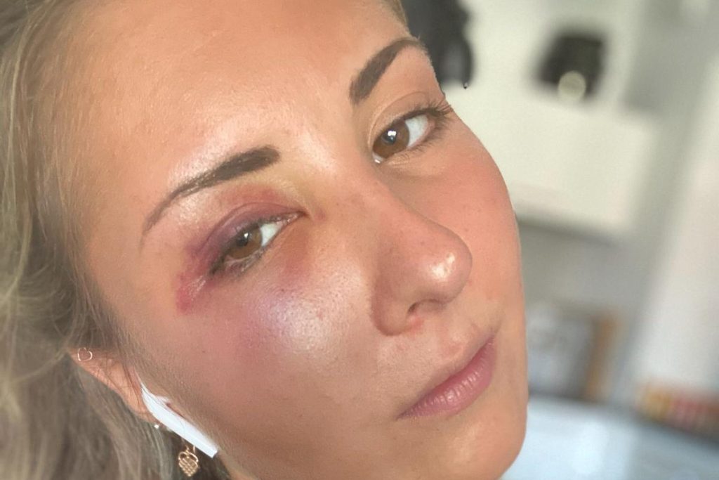 Στρασβούργο: Αλλοδαποί «πρόσφυγες» ξυλοκόπησαν κοπέλα γιατί… φόρεσε κόκκινη φούστα! (φώτο-βίντεο)