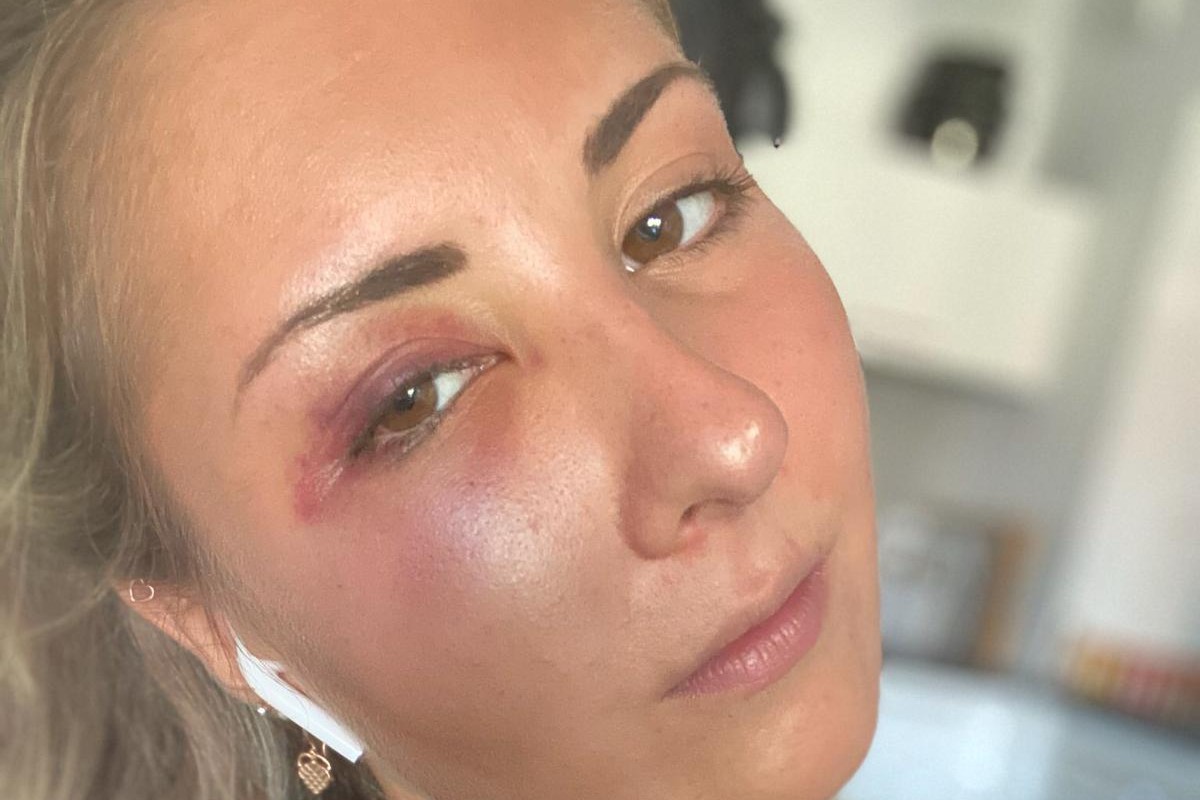 Στρασβούργο: Αλλοδαποί «πρόσφυγες» ξυλοκόπησαν κοπέλα γιατί… φόρεσε κόκκινη φούστα! (φώτο-βίντεο)