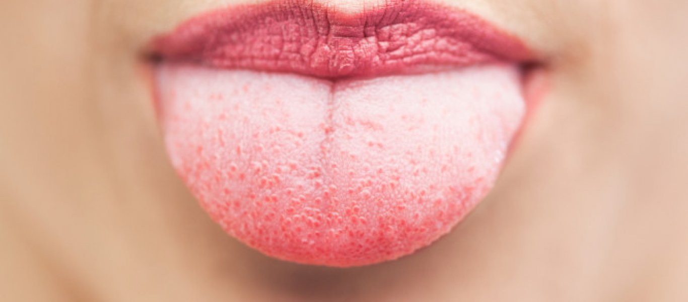 Δείτε τι αποκαλύπτει το χρώμα της γλώσσας σας για την υγεία σας