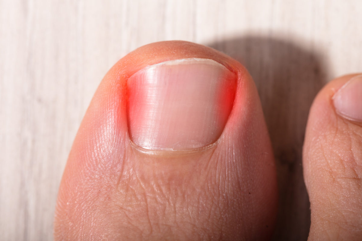Νύχι που μπαίνει μέσα στο δέρμα: Τι να κάνετε για να το αντιμετωπίσετε