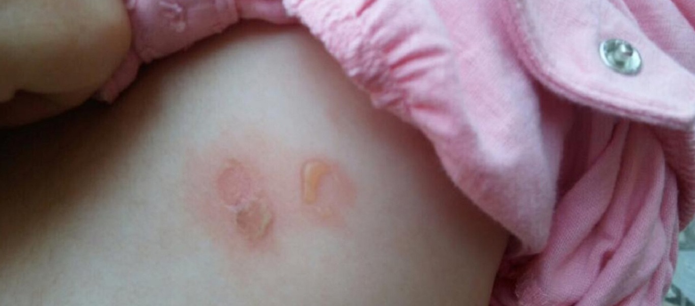 Σταφυλόκοκκος: Τι είναι και τι πρέπει να κάνεις για να τον αντιμετωπίσεις