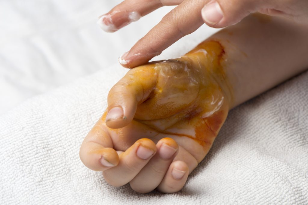 Καήκατε καθώς τηγανίζατε; – Δείτε πως πρέπει να το αντιμετωπίσετε