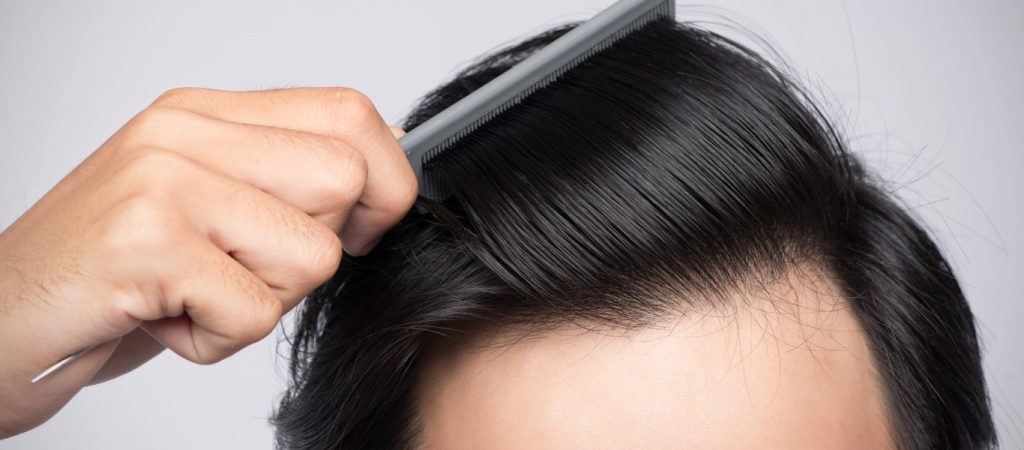 Αραίωση μαλλιών: Aυτές είναι οι 4 απρόσμενες αιτίες
