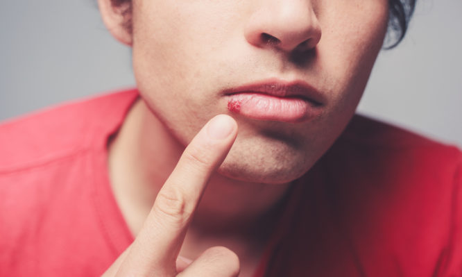 Επιχείλιος έρπης: Aίτια, συμπτώματα και πως να τον αντιμετωπίσετε