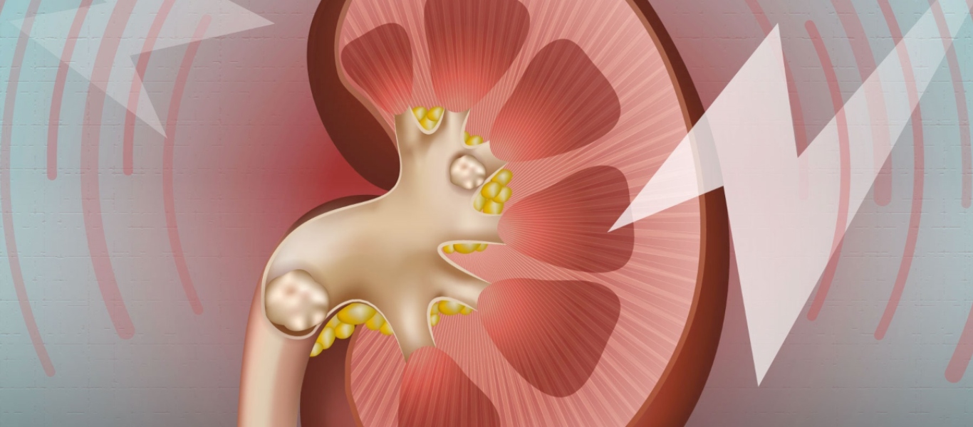 Οι τροφές που πρέπει να αποφύγετε εάν έχετε πέτρα στα νεφρά