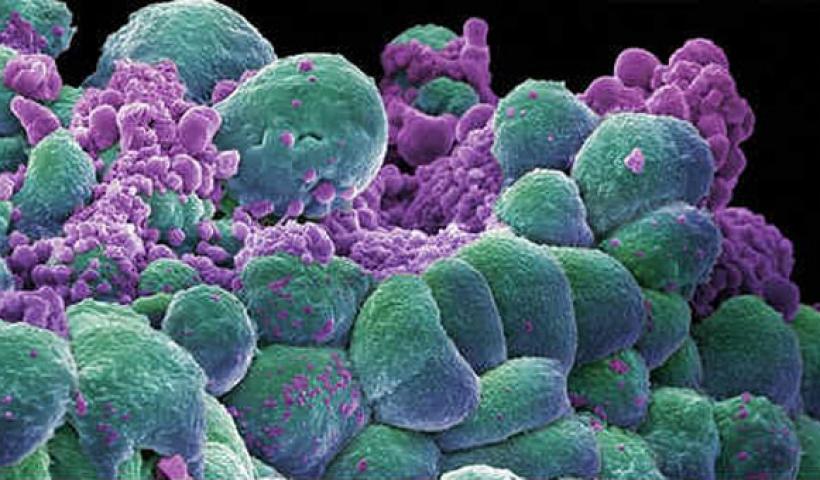 Πώς τα καρκινικά κύτταρα «χτυπούν» τα υγιή και δημιουργούν τους όγκους (βίντεο)