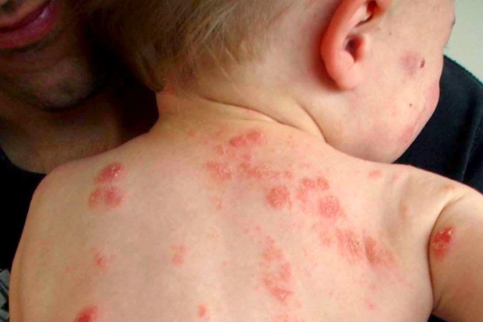 Σταφυλόκοκκος στο παιδί: Επιπλοκές και τρόποι αντιμετώπισης
