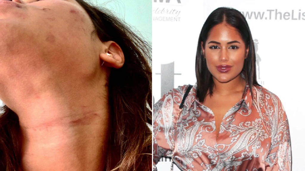 Μαλίν Άντερσον: Σοκάρει η ριάλιτι σταρ δείχνοντας τα σημάδια του ξυλοδαρμού από τον σύντροφο της (βίντεο)