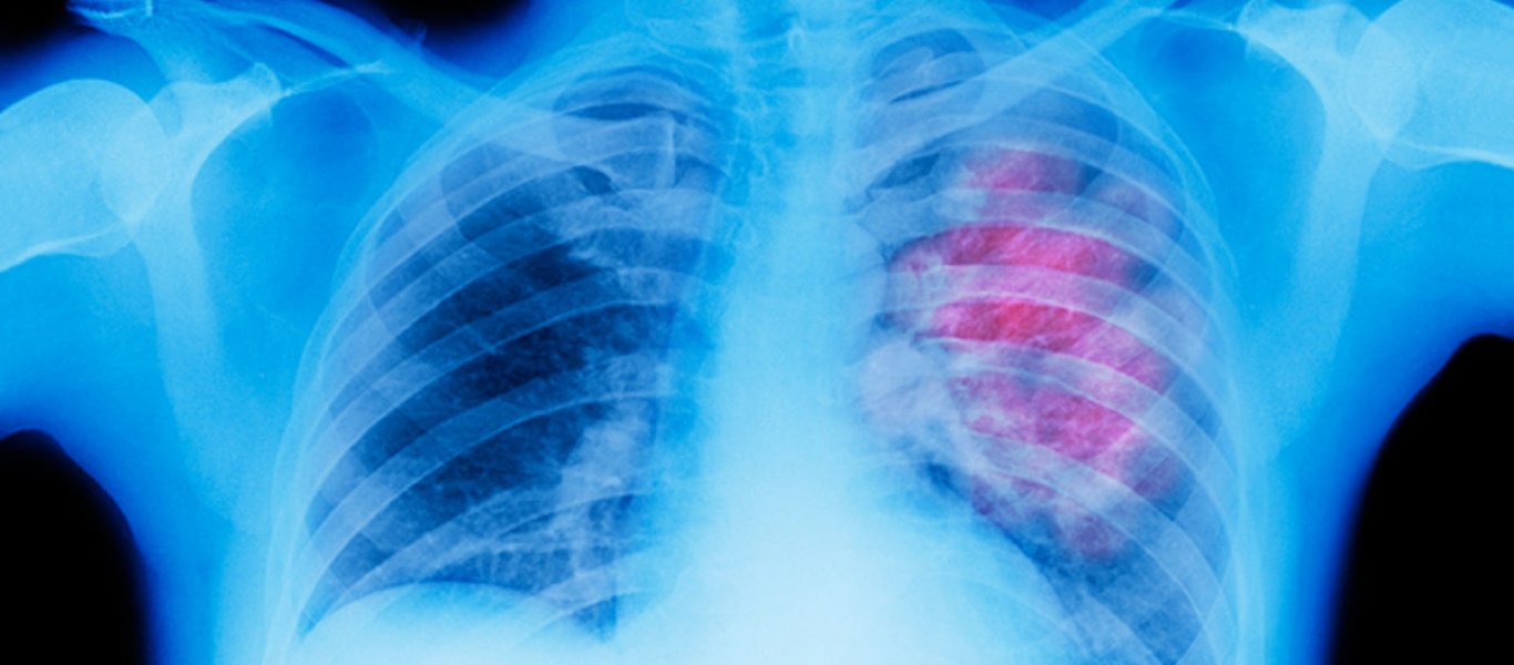 Καρκίνος του πνεύμονα: Τα συμπτώματα που εμφανίζονται ακόμα και στα μάτια