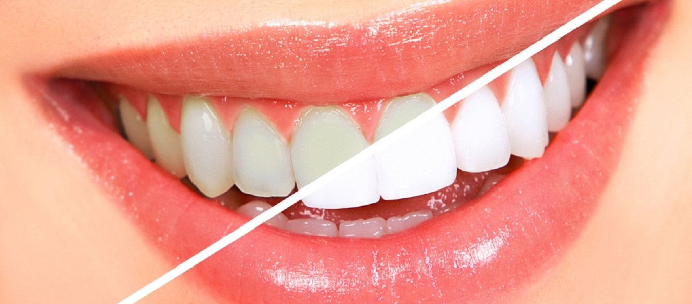 Αυτοί είναι οι λόγοι που τα δόντια μας… αλλάζουν χρώμα