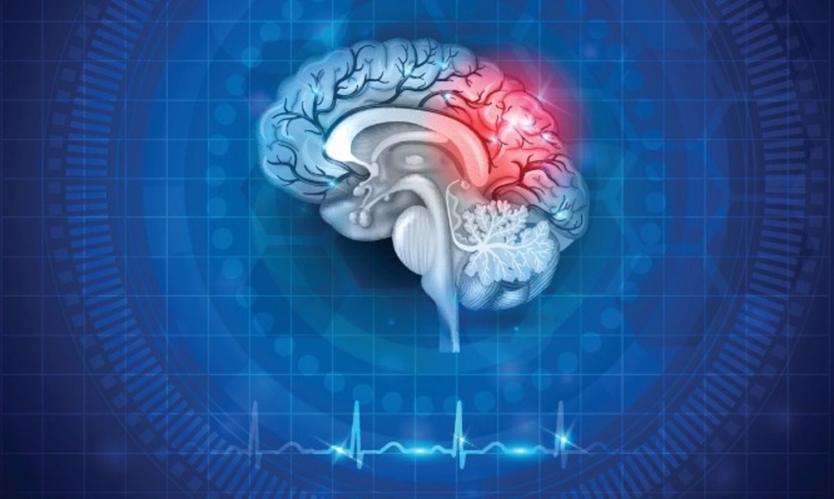 Ανεύρυσμα εγκεφάλου: Τα συμπτώματα που χρειάζονται ιδιαίτερη προσοχή