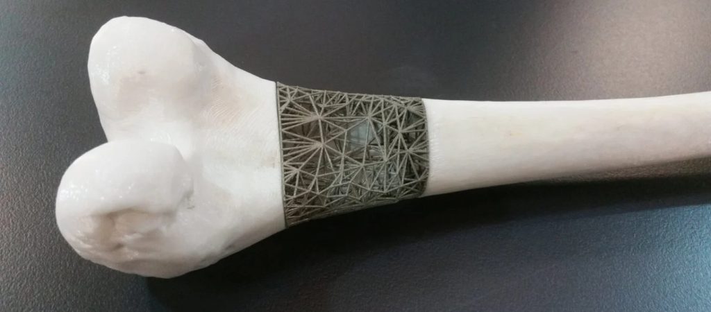 Η τεχνολογία στην διάθεση της ιατρικής – 3D οστά στο σώμα του ασθενή (βίντεο)