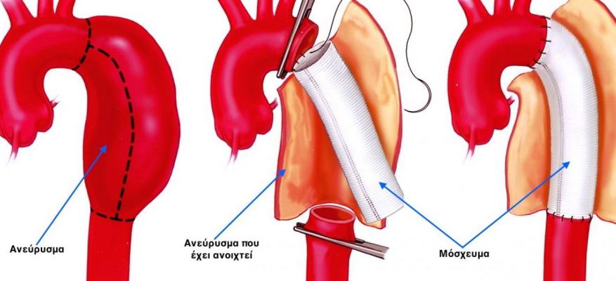Ανεύρυσμα αορτής: Πότε θα πρέπει να κάνετε τσεκάπ