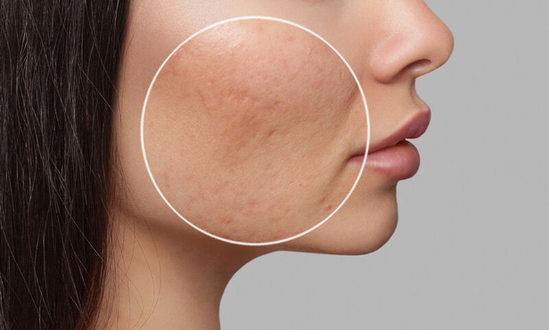 Ακμή μετά τα 30: Nα που μπορεί να οφείλεται