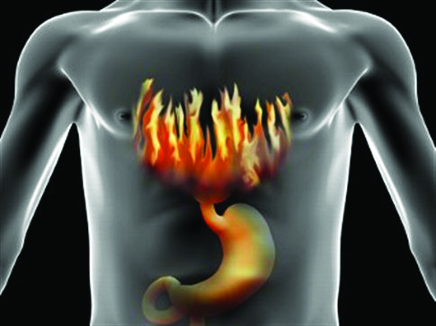 Οι τροφές που ευθύνονται για την γαστροοισοφαγική παλινδρόμηση – Τα συμπτώματα