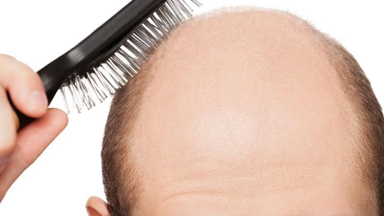 Τριχόπτωση και φαλάκρα: Ποιο συνήθειο στο ντουζ πρέπει να αποφεύγετε