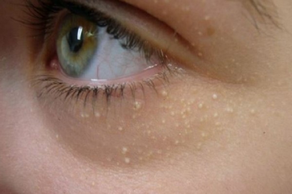Λευκά σπυράκια γύρω από τα μάτια: Πως προκαλούνται και τι να κάνετε για να τα ξεφορτωθείτε