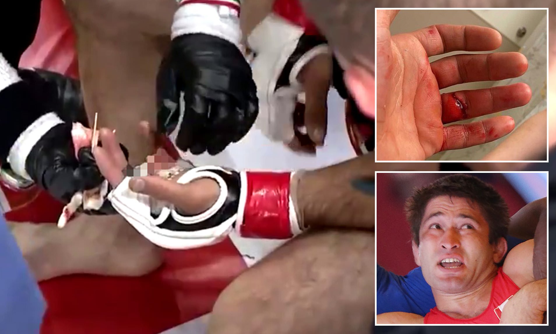 Σοκαριστικός τραυματισμός σε αγώνα ΜΜΑ – Κόπηκε το δάχτυλό του & βγήκε ανακοίνωση για τον… εντοπισμό του (φώτο-βίντεο)