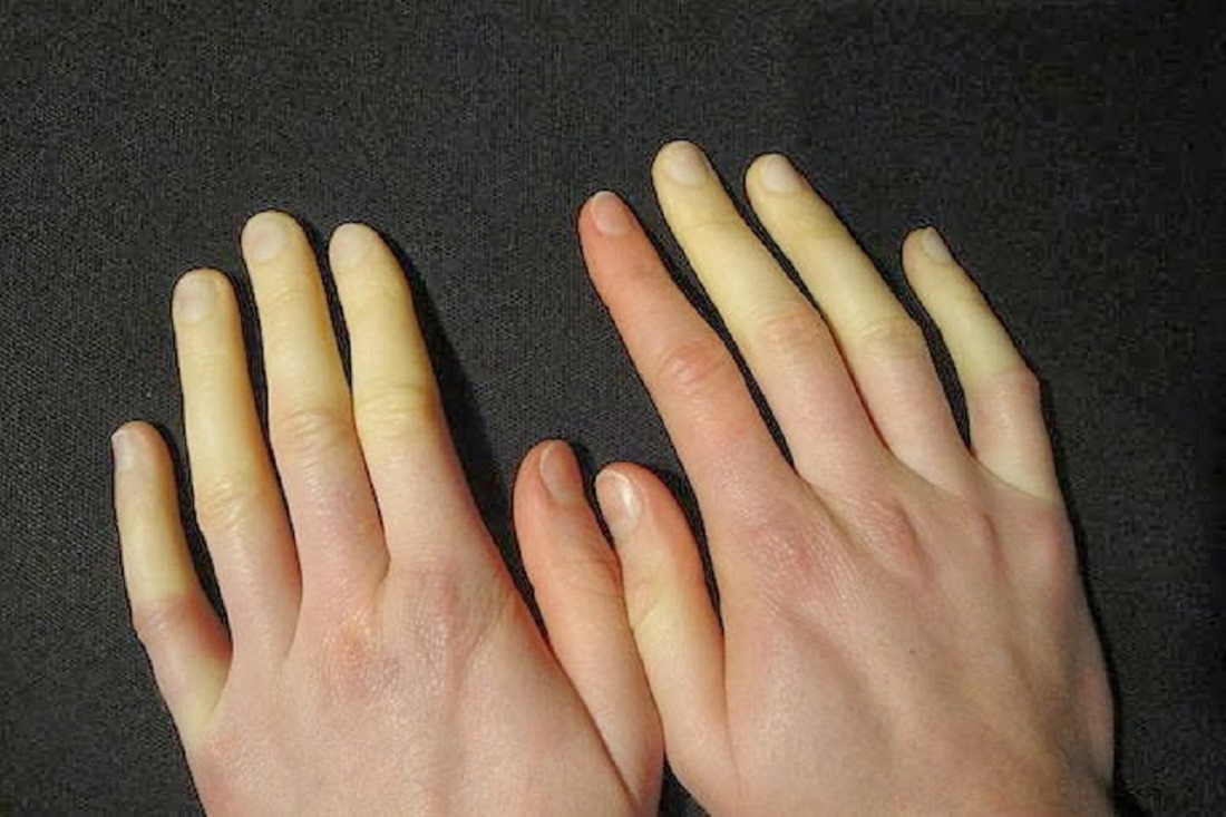 Σύνδρομο Ρεϊνό: Η σπάνια ασθένεια που κάνει τα δάχτυλα άσπρα ή μπλε (φώτο-βίντεο)