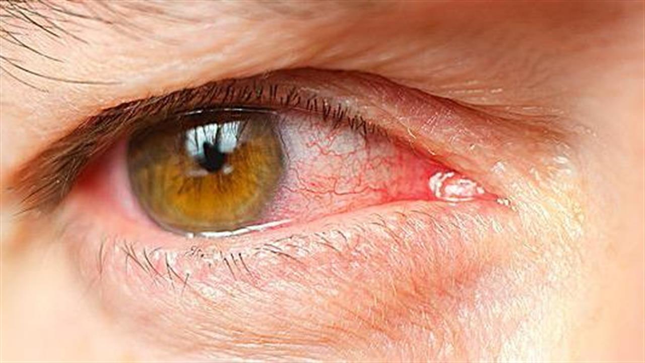 Δείτε τι πρέπει να κάνετε για να αποφύγετε την εαρινή επιπεφυκίτιδα