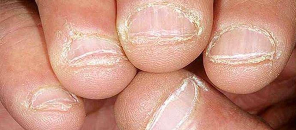 Ο τεράστιος κίνδυνος που αντιμετωπίζετε αν πειράζετε το δέρμα γύρω από τα νύχια σας